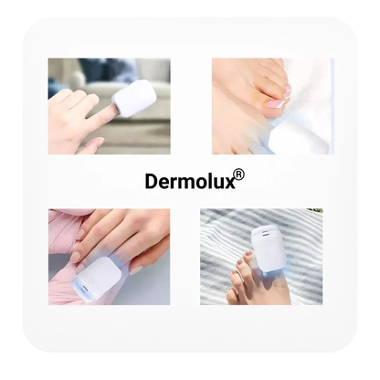 Dermolux ® - Dispositivo láser para tratamiento de hongos en las uñas