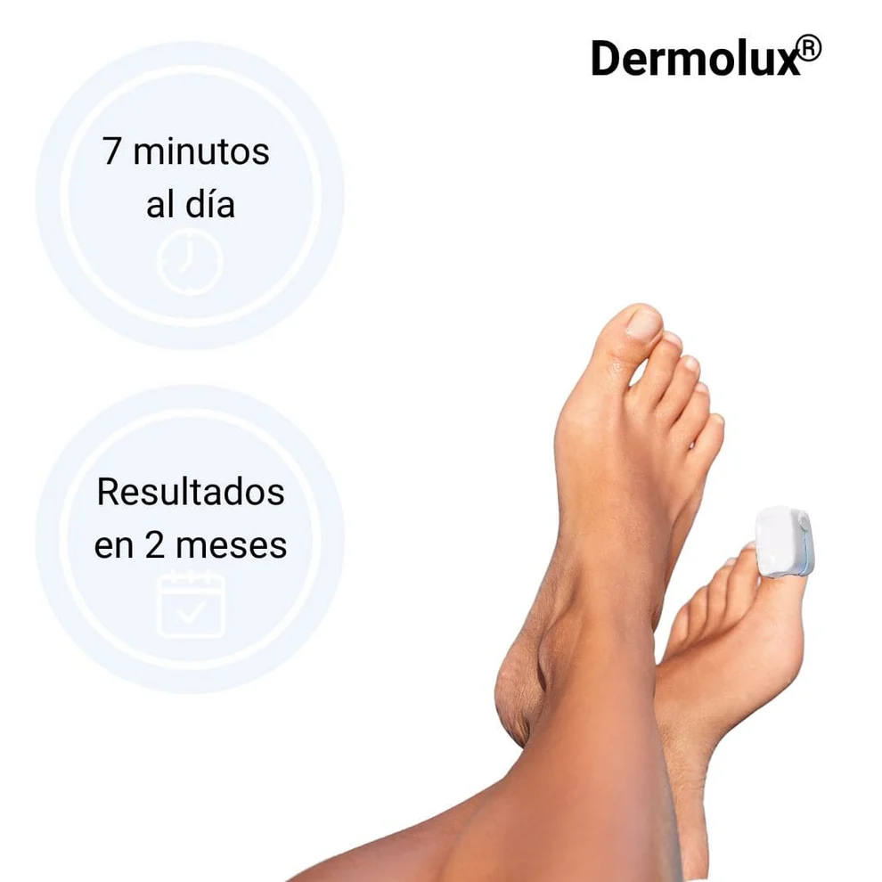 Dermolux ® - Dispositivo láser para tratamiento de hongos en las uñas